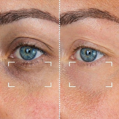 LVMISENS™ - Le Smart Eye Lift